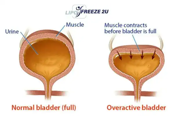 diagram of overactive bladder treatment Congleton