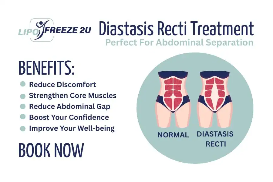 How Long Will It Take to See Improvements in Diastasis Recti Congleton
