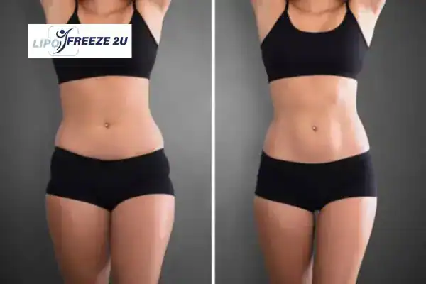 How Can LIPO FREEZE 2U Support Your Post-Pregnancy Body Recovery Congleton?