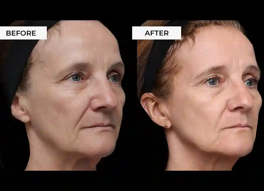 How Many RF Microneedling Sessions Will You Need to See a Difference Congleton?