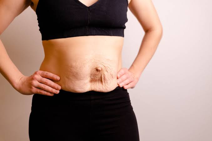 Is Surgery Really the Only Way to Repair Diastasis Recti Congleton?