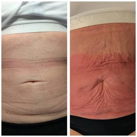 How Does RF Microneedling Improve Crepey, Thin and Uneven Skin Texture Congleton?