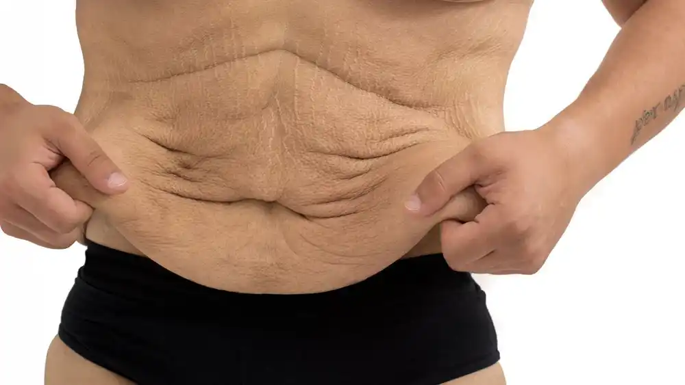 RF Microneedling for Loose Skin: How Can It Help Tighten and Reshape the Skin Congleton?
